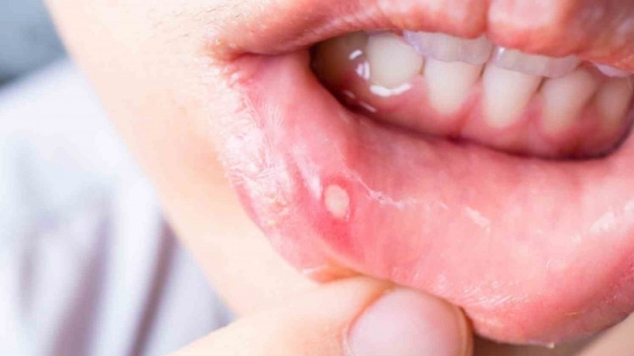 Sık kullanılan ağız gargaraları bu hastalığa sebep olabilir