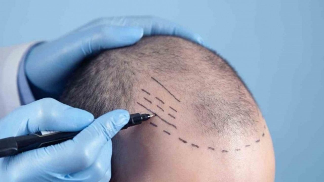 Dünyanın en iyi saç ekim merkezleri Türkiye’de