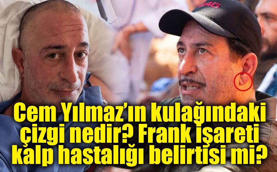 Cem Yılmaz’ın kulağındaki çizgi neden gündem oldu? Uzmanlar “Frank işareti”ne dikkat çekti